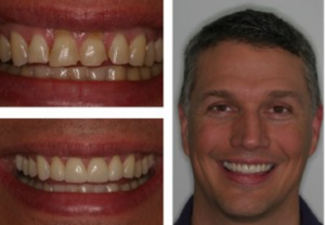 before and after image of smiling man who received anterior crowns as example of optimal patient outcomes