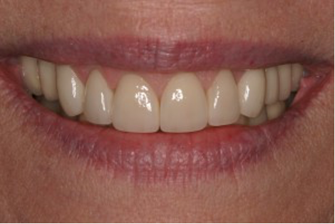close up image of teeth showing after crown restoration as example of positive patient outcomes