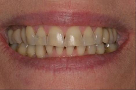 close up image of teeth showing before crown restoration