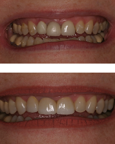 before and after image of replacement of veneers with crowns and whitening as example of positive patient outcomes