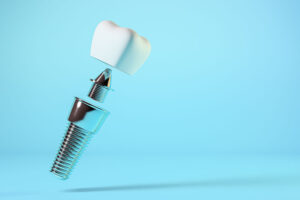 image of prosthetic dental implant