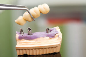 close up of model of implant-supported dental bridge and instructions for life after implant-supported bridges and maintenance and care for longevity.